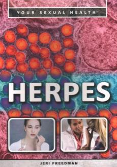 Herpes