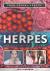 Herpes