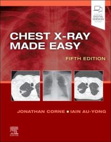 Chest x-ray made easy